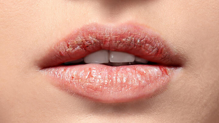 A closeup of a beautiful young woman with very dry and flaking lips